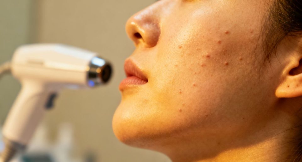 Can Exion Help With Acne Scars?