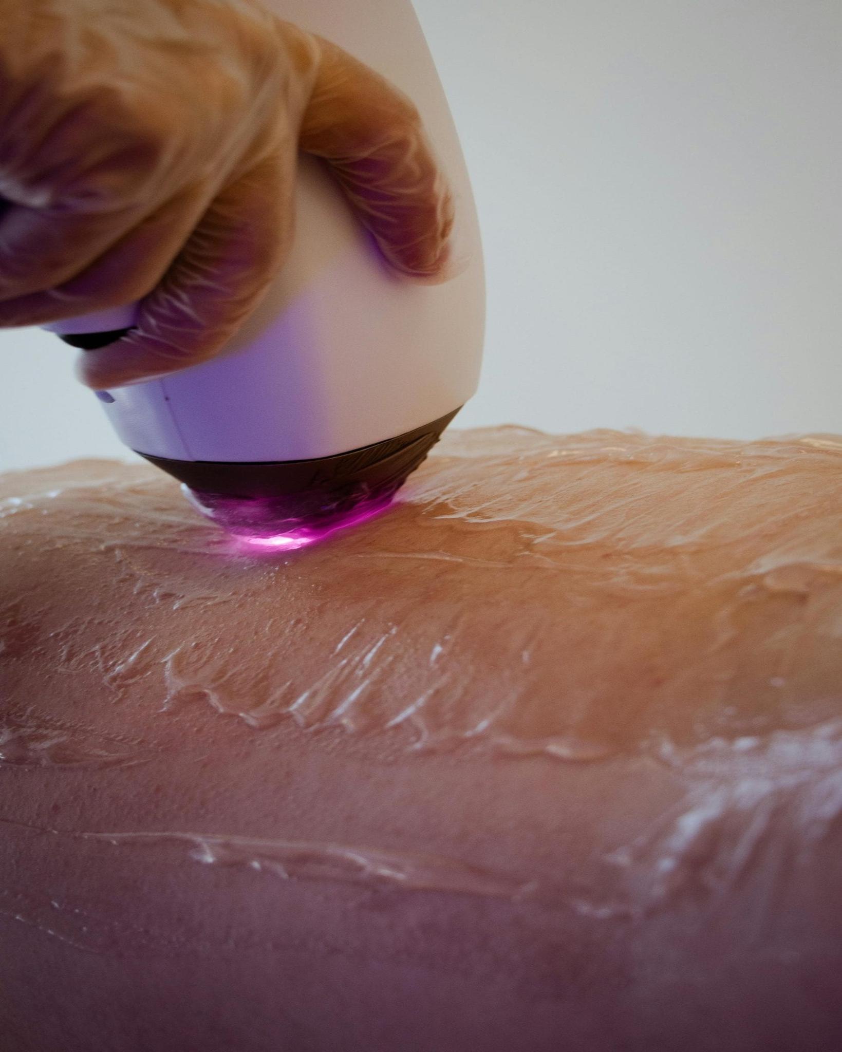 a person receiving laser hair removal